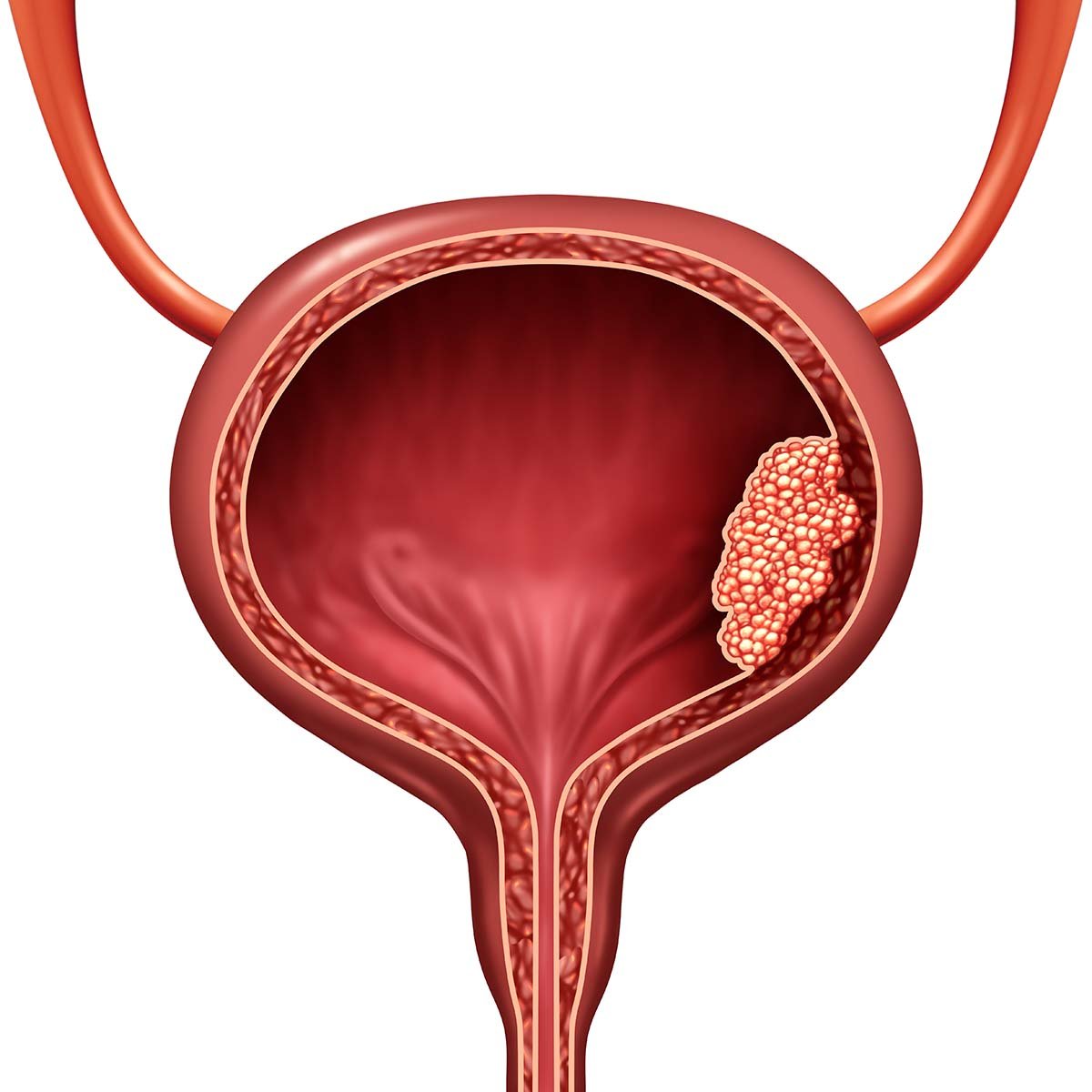 Bladder Cancer