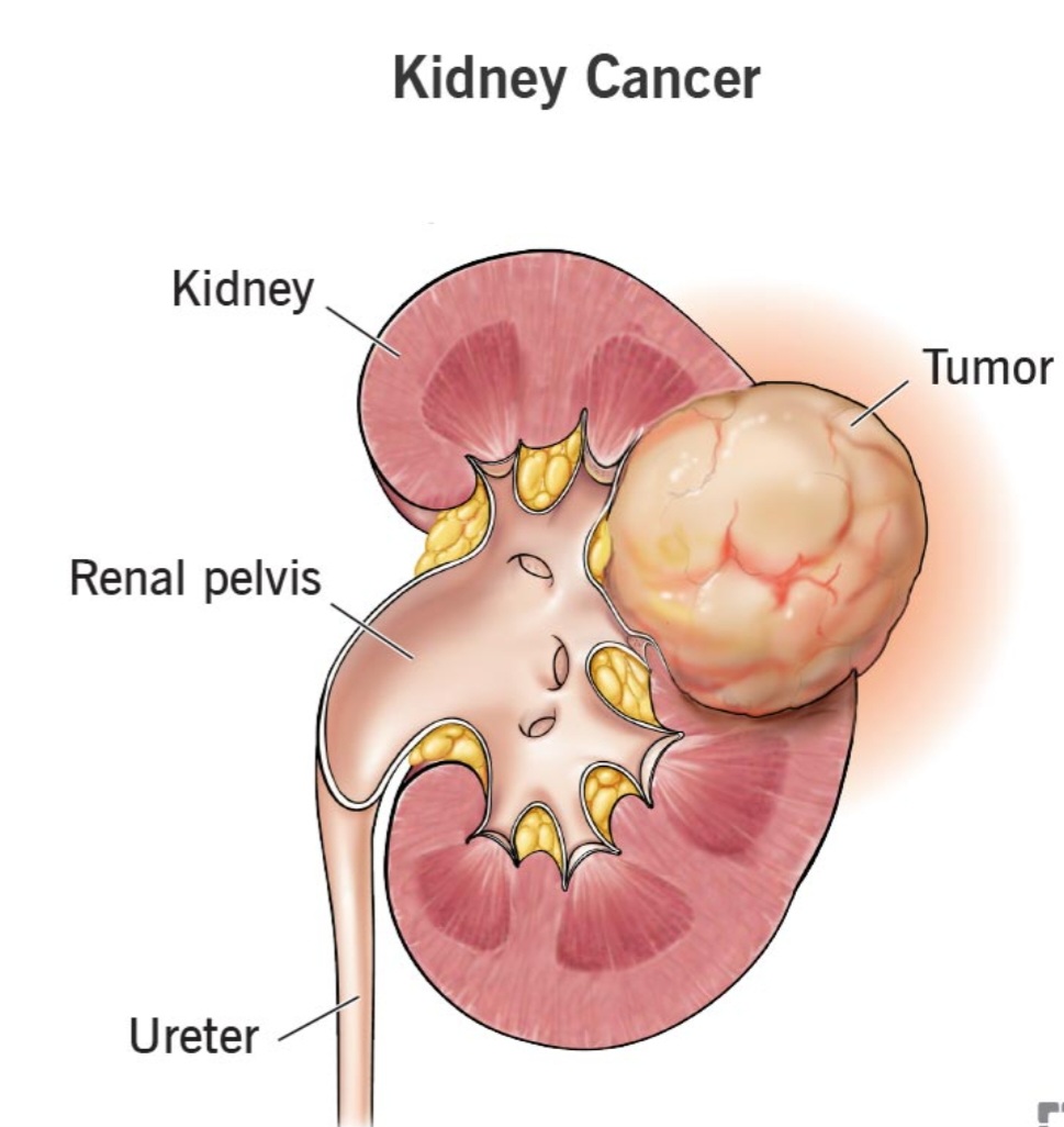 Kidney Cancer
