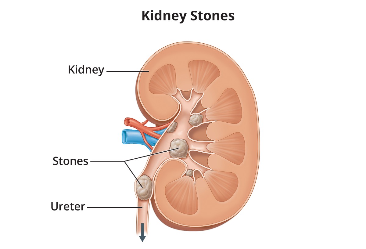 Kidney Stones