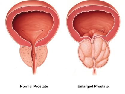 Prostate Enlargement