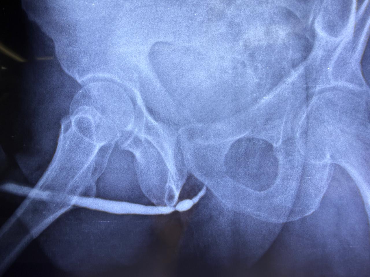 Urethral Stricture
